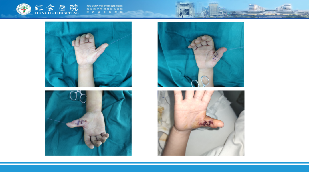 骨科实战：手外伤急诊处理原则精要