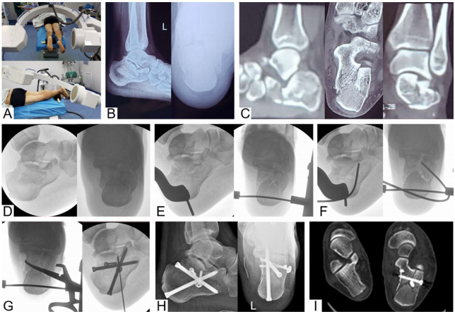 龙氏跟骨微创技术：三步闭合复位经皮螺钉固定