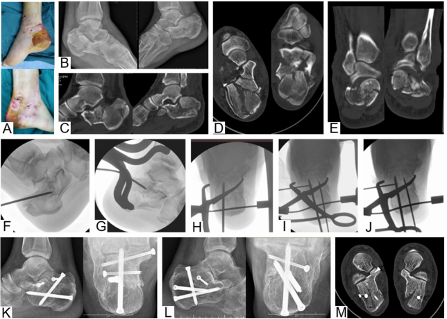 龙氏跟骨微创技术：三步闭合复位经皮螺钉固定