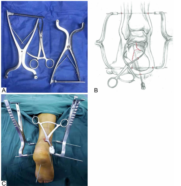 龙氏跟骨微创技术：三步闭合复位经皮螺钉固定