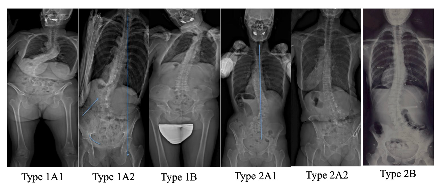 重磅学术动态：成人胸腰椎脊柱畸形手术固定节段的选择：JBJS