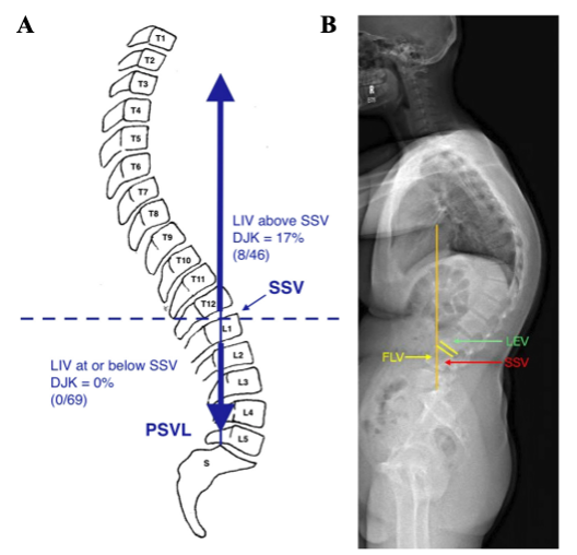 重磅学术动态：成人胸腰椎脊柱畸形手术固定节段的选择：JBJS