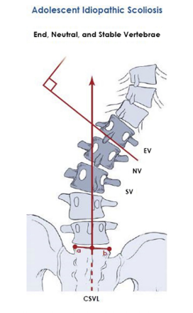 重磅学术动态：成人胸腰椎脊柱畸形手术固定节段的选择：JBJS