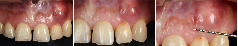 病例报告：显微外科手术联合使用引导组织再生技术治疗根尖囊肿