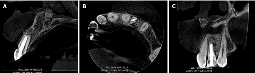 病例报告：显微外科手术联合使用引导组织再生技术治疗根尖囊肿