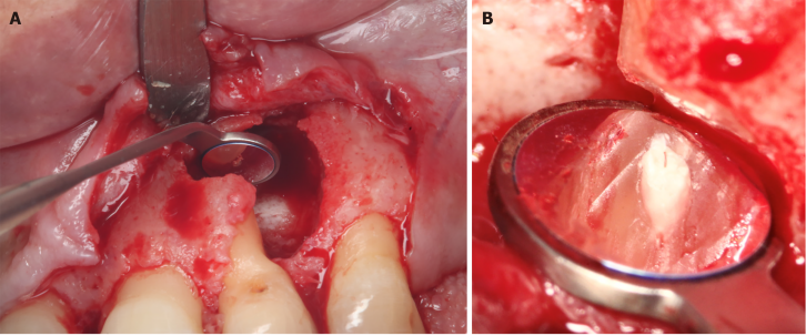 病例报告：显微外科手术联合使用引导组织再生技术治疗根尖囊肿