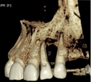 病例报告：显微外科手术联合使用引导组织再生技术治疗根尖囊肿