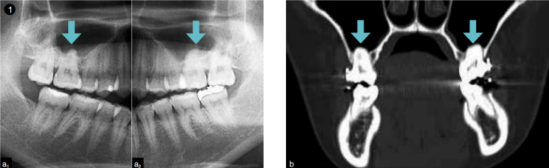 拔牙导致上颌窦穿孔的应对策略