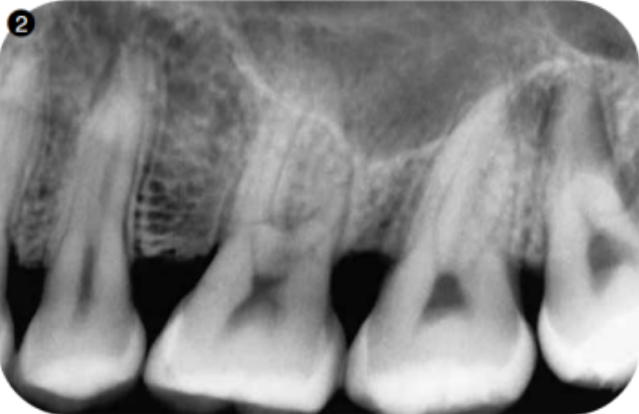 拔牙导致上颌窦穿孔的应对策略