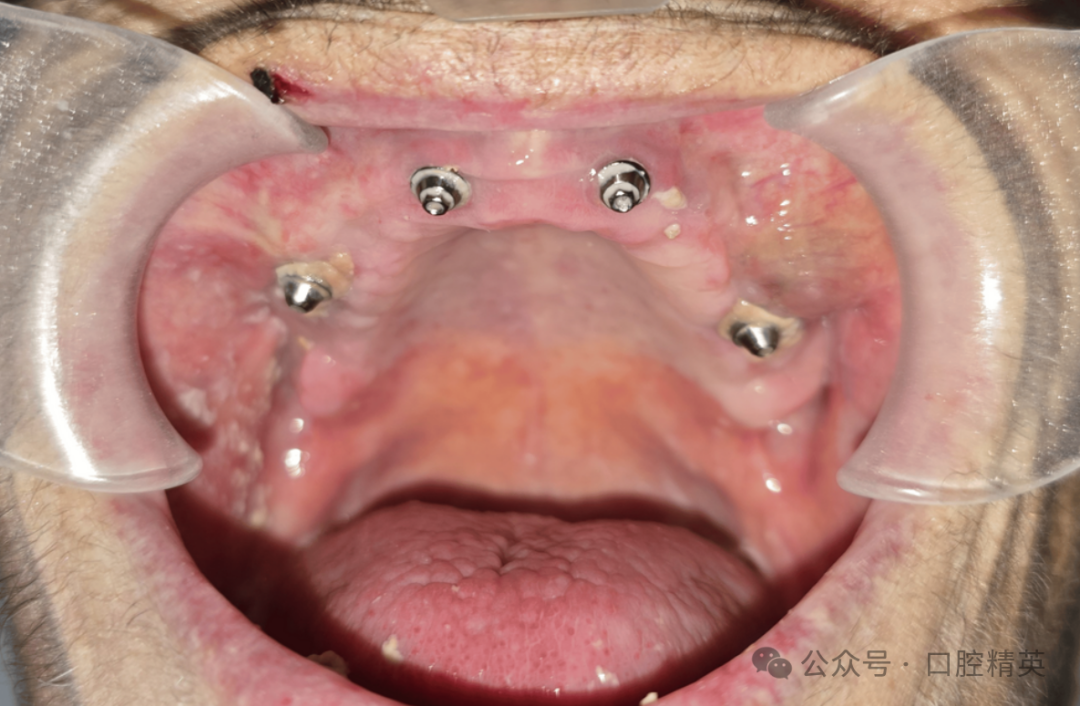 使用抗凝药物，老年患者牙种植术后严重出血！