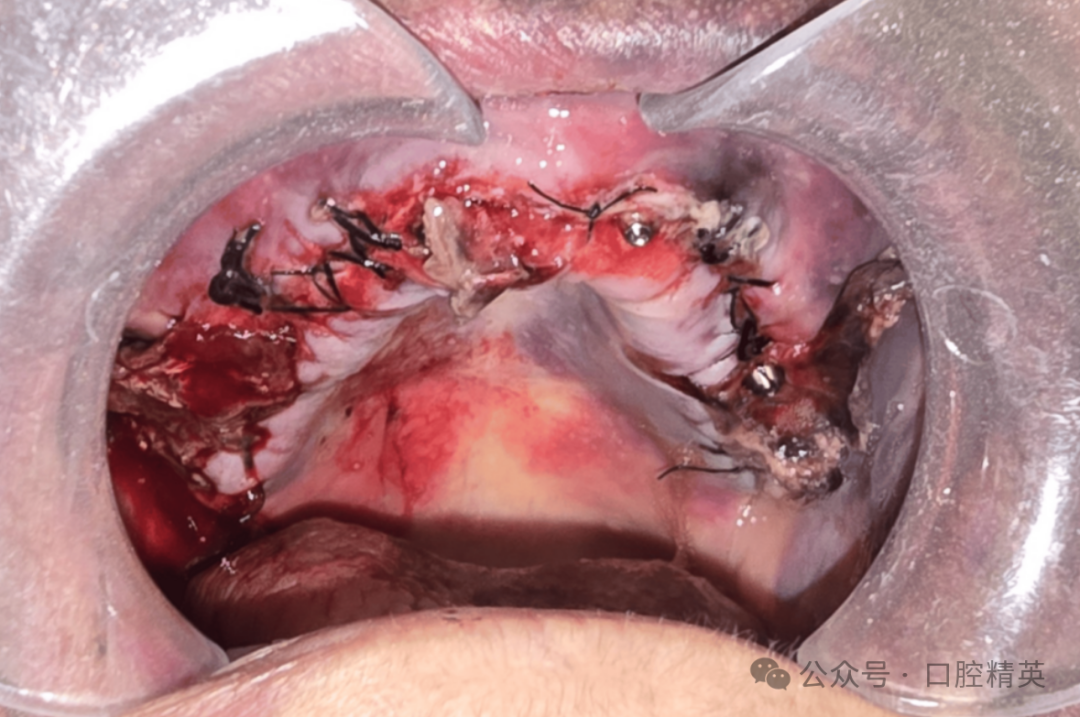 使用抗凝药物，老年患者牙种植术后严重出血！