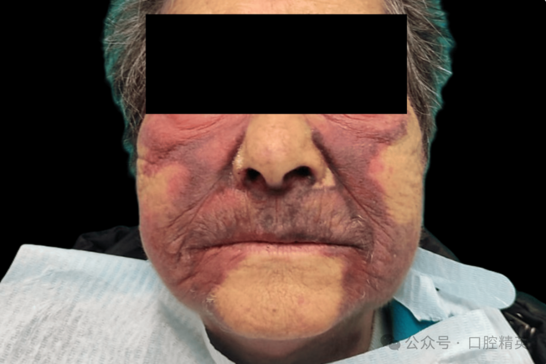 使用抗凝药物，老年患者牙种植术后严重出血！