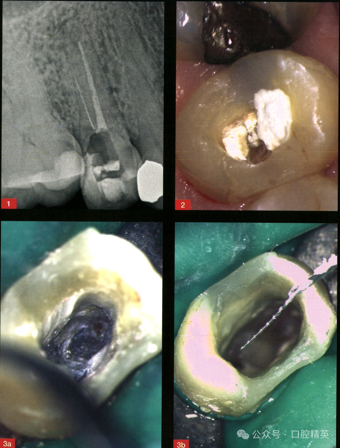 使用“万能胶”取出根管内《分离器械》