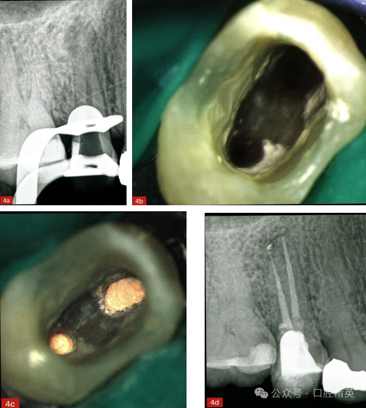 使用“万能胶”取出根管内《分离器械》