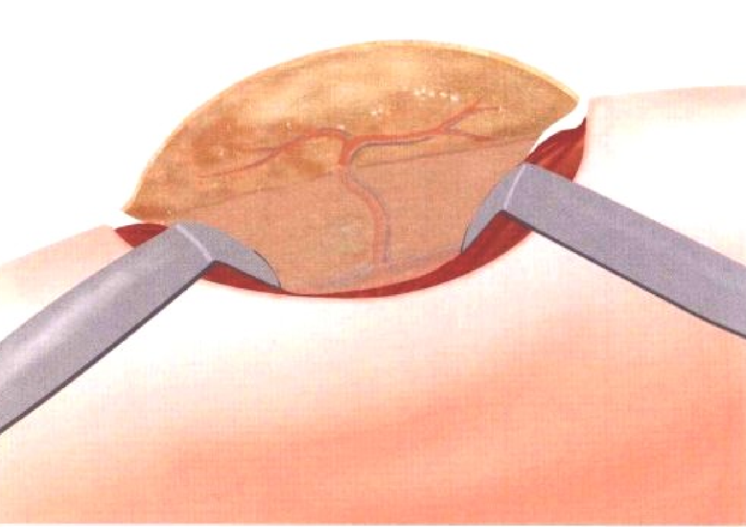 皮瓣的设计及切取要点