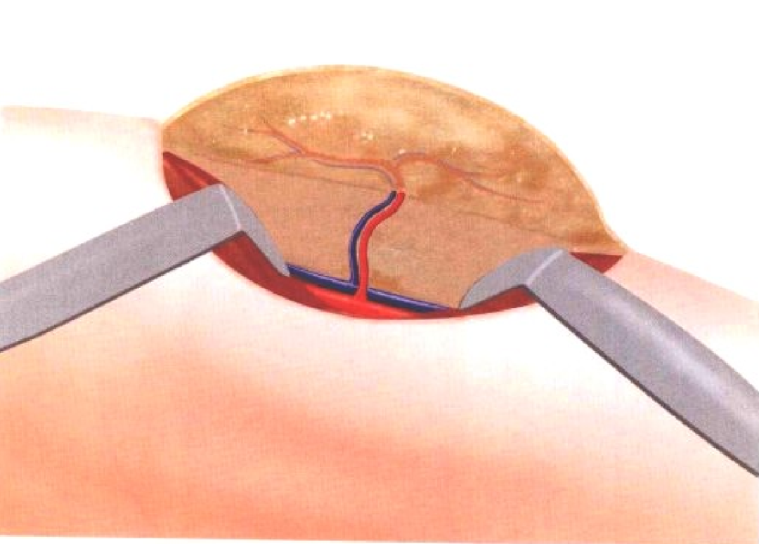 皮瓣的设计及切取要点