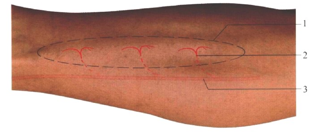 皮瓣的设计及切取要点