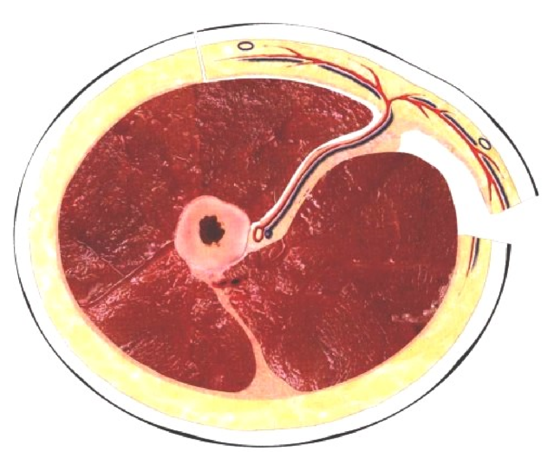 皮瓣的设计及切取要点