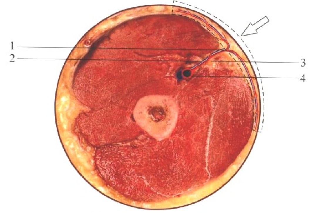 皮瓣的设计及切取要点