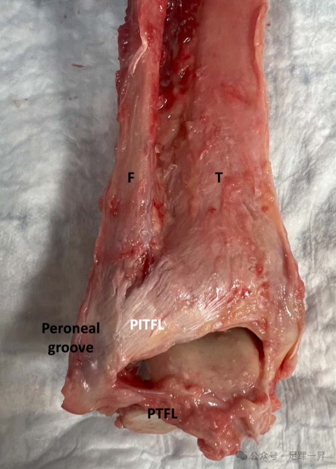 下胫腓联合不稳