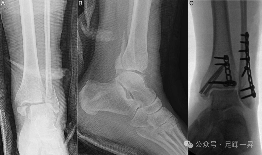 下胫腓联合不稳