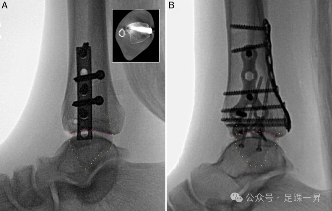 下胫腓联合不稳