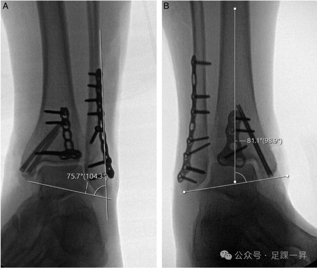 下胫腓联合不稳
