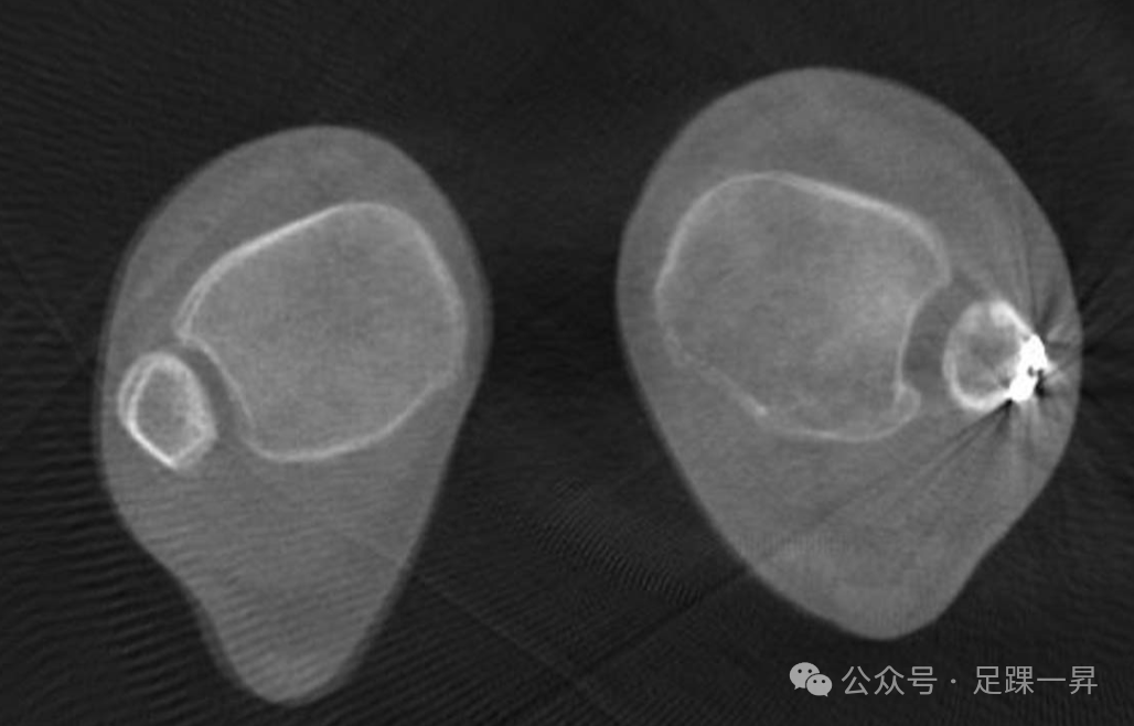 下胫腓联合不稳