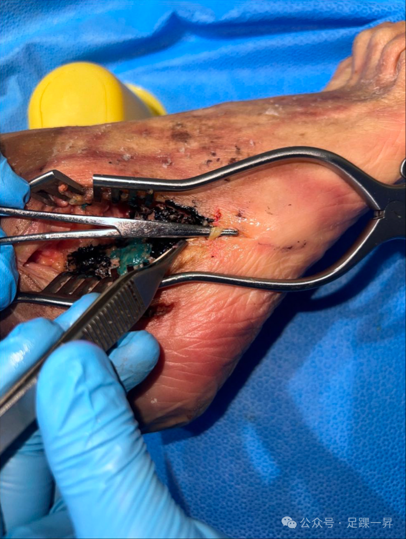 手术技巧｜改良跗骨窦入路增加跟骨体外侧及距下关节显露范围