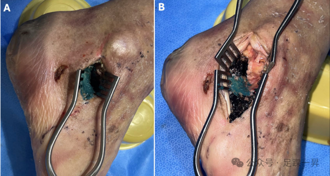 手术技巧｜改良跗骨窦入路增加跟骨体外侧及距下关节显露范围