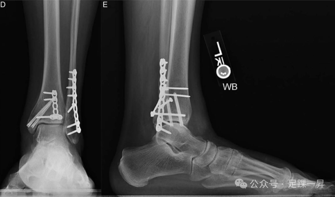 下胫腓联合不稳