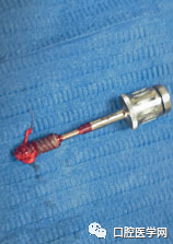 忘调转速，植体撕裂神经