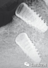 忘调转速，植体撕裂神经