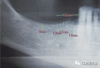 忘调转速，植体撕裂神经