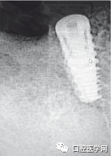 忘调转速，植体撕裂神经