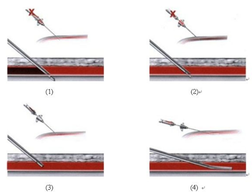 经桡动脉及远端桡动脉穿刺技术，干货满满！