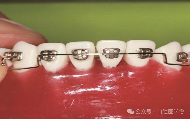 深覆颌矫正：何时压低前牙？何时升高后牙？