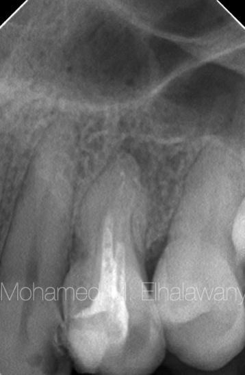 【病例报告】没拍片，误诊误治7个月