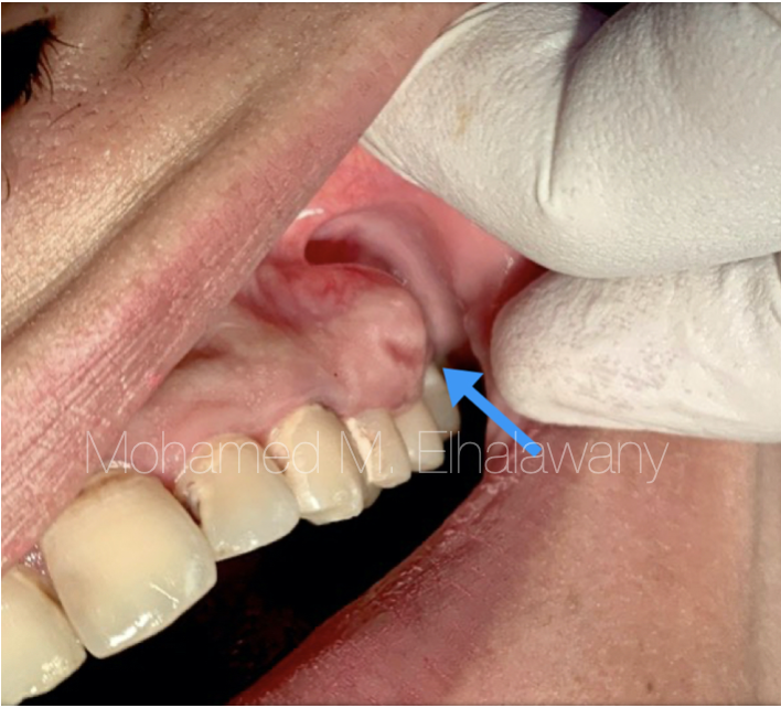 【病例报告】没拍片，误诊误治7个月
