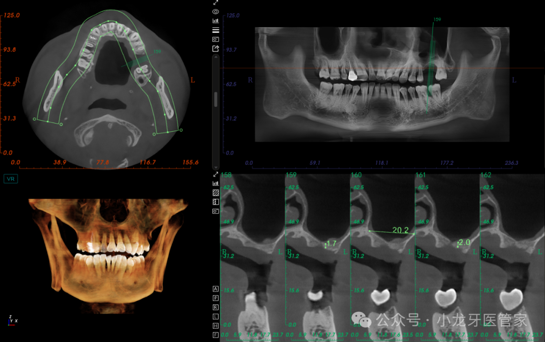 病例分享：上颌窦外提升术一例