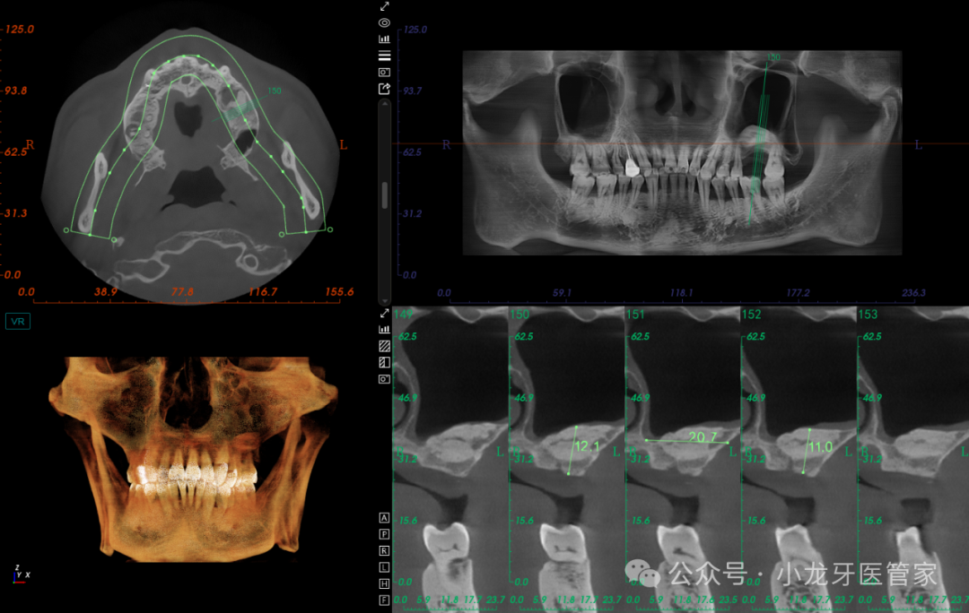 病例分享：上颌窦外提升术一例
