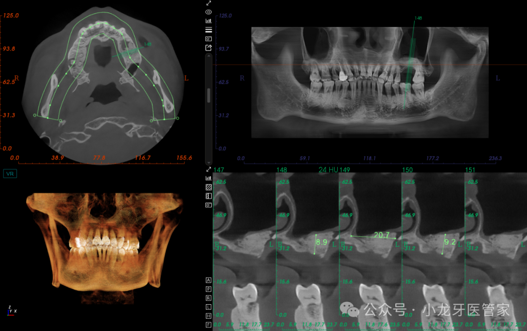 病例分享：上颌窦外提升术一例