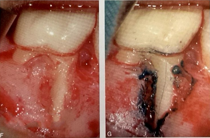 牙根纵裂的诊断和鉴别诊断