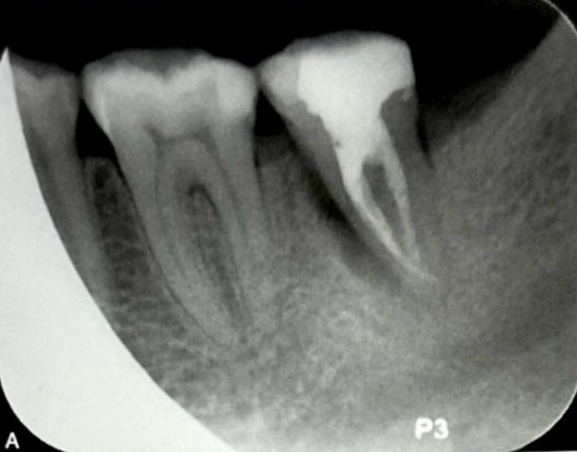 牙根纵裂的诊断和鉴别诊断