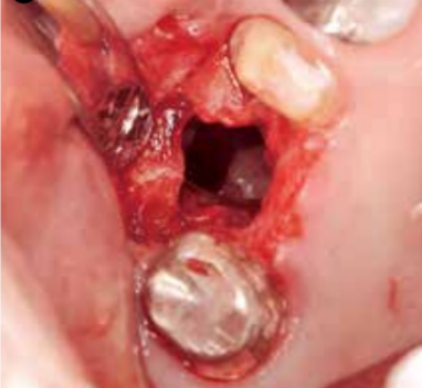 拔牙导致上颌窦穿孔的应对策略