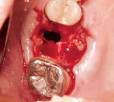 拔牙导致上颌窦穿孔的应对策略