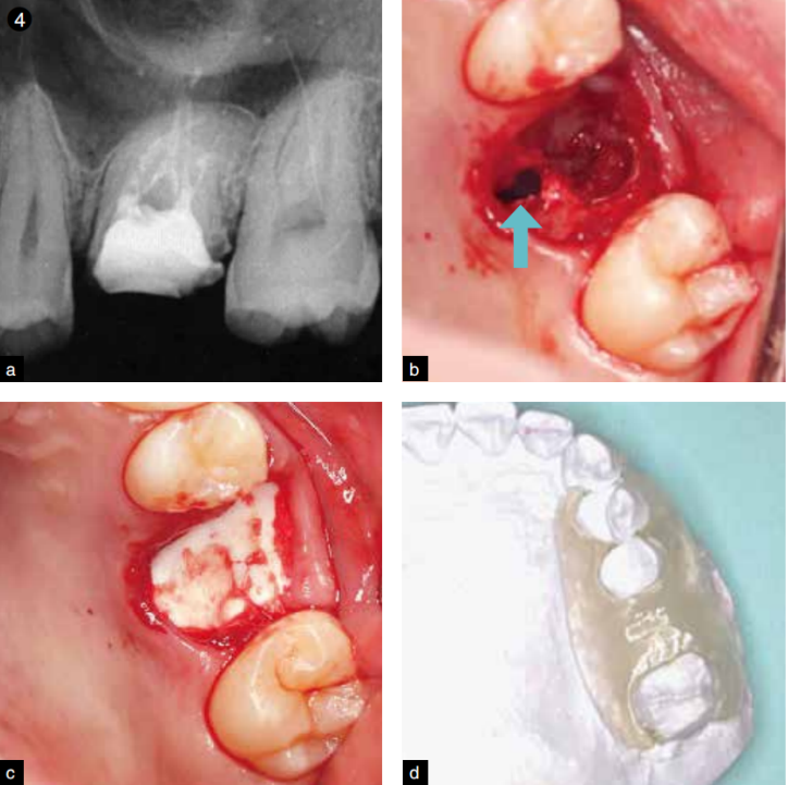 拔牙导致上颌窦穿孔的应对策略