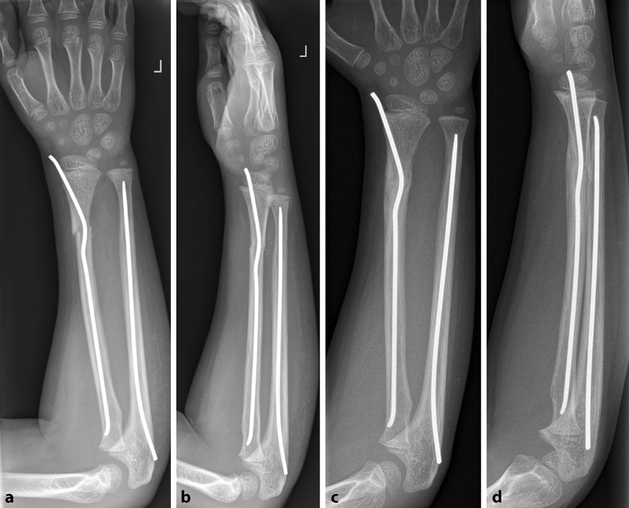 【手术技巧】不仅仅是微创：弹性髓内钉如何应对儿童桡骨骨折的“不稳定”挑战？