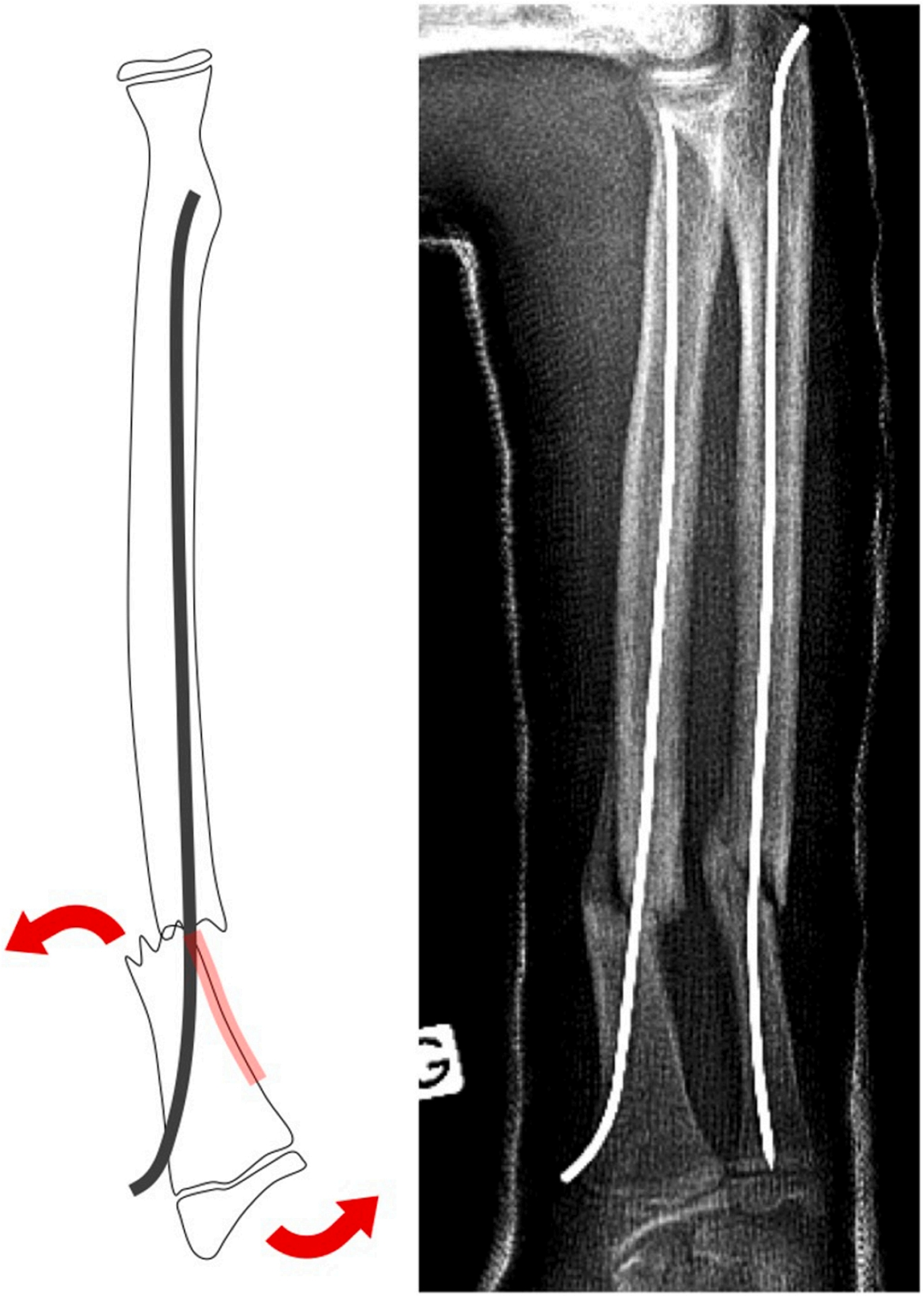 【手术技巧】不仅仅是微创：弹性髓内钉如何应对儿童桡骨骨折的“不稳定”挑战？
