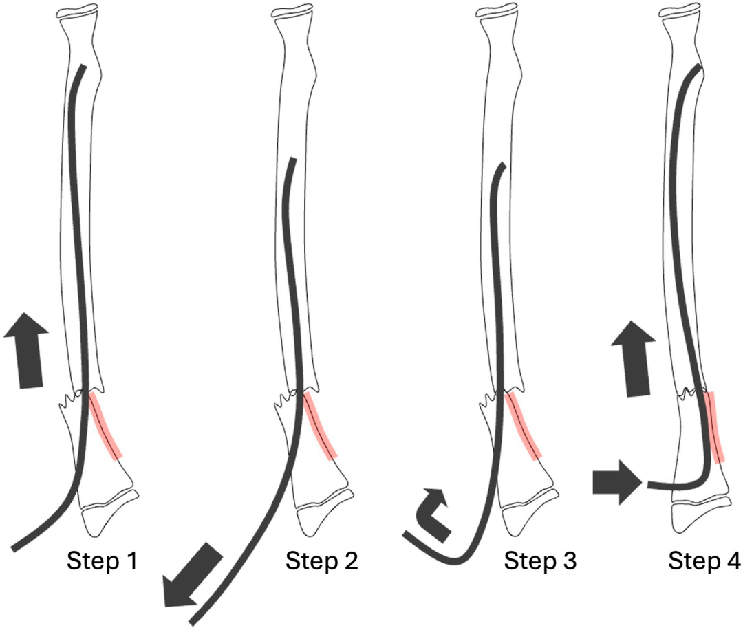 【手术技巧】不仅仅是微创：弹性髓内钉如何应对儿童桡骨骨折的“不稳定”挑战？